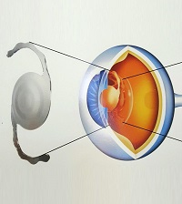 Lentes Intraoculares